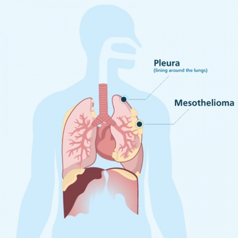 Pleural Mesothelioma Centre and Mesothelioma Support